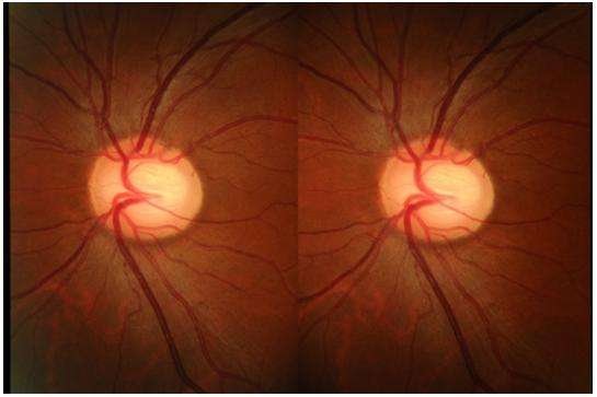 眼底立体照相检查视神经的形态改变