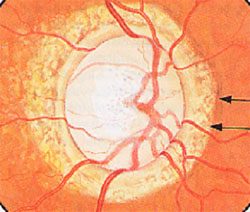 glaucomadisk